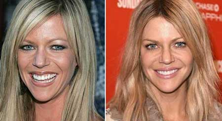 Kaitlin Olson Before and After Plastic Surgery